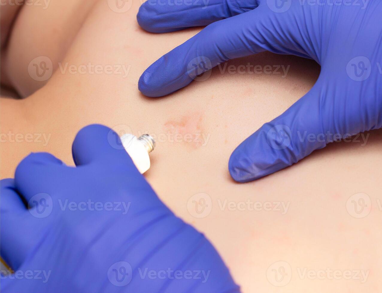 Doctor cosmetologist smears healing ointment scar and scar to the man on the back for healing, close-up, medical photo