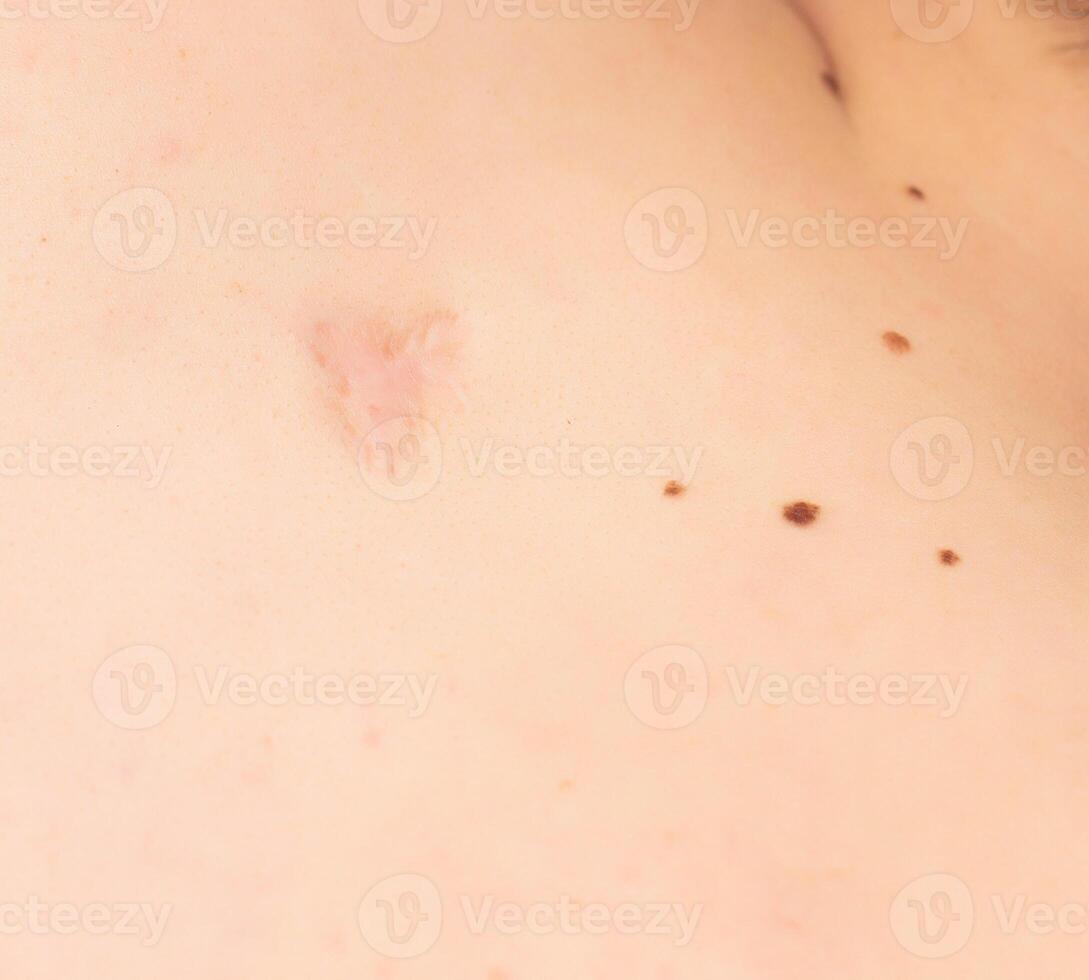 Big scar and moles on the skin of a person on the back, copy space, dermatology photo