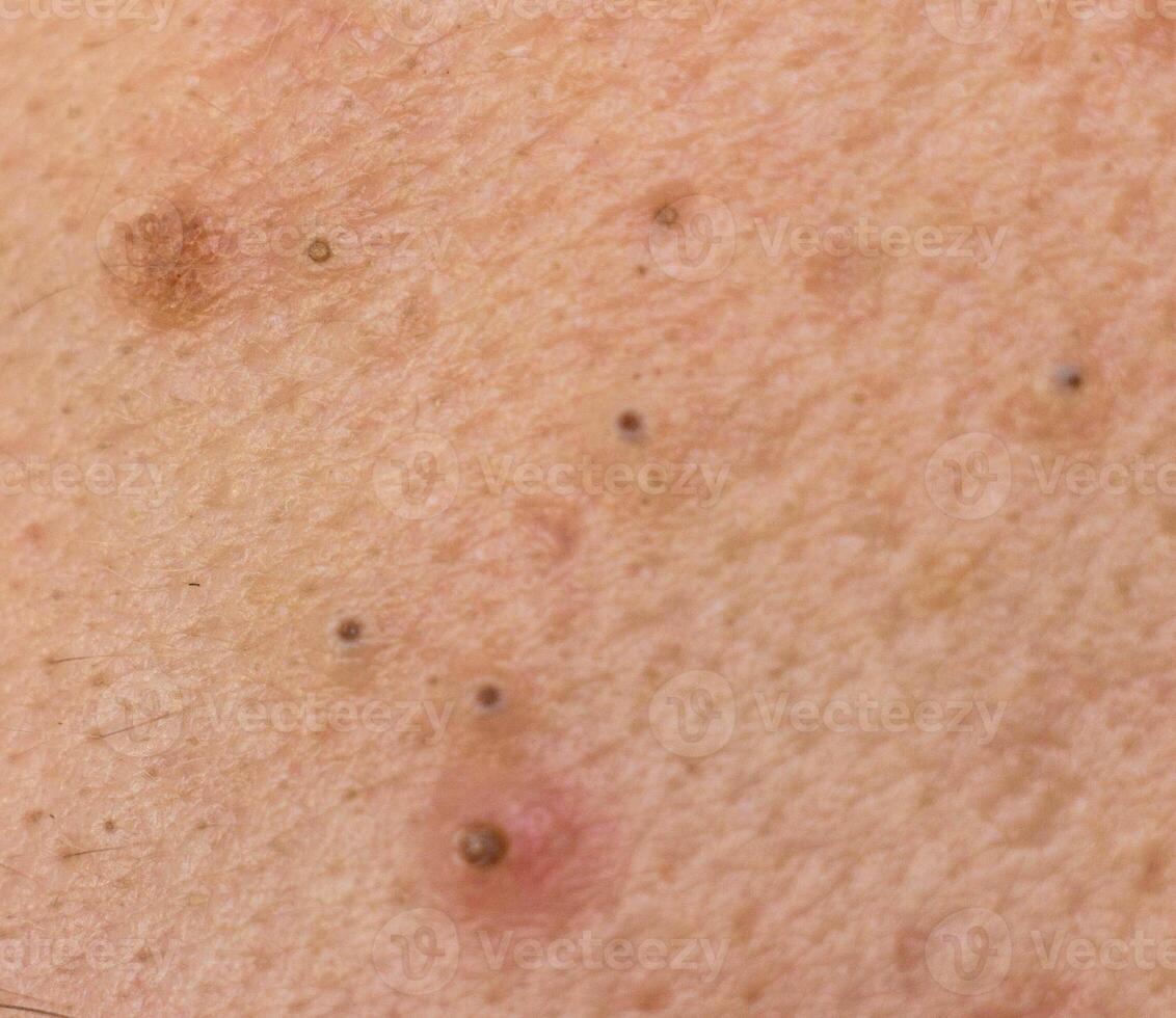 Black dots on face and pimples macro, comedo photo