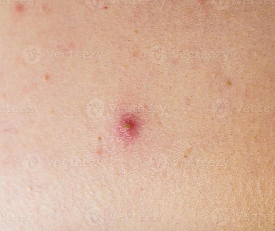 Red pimple on face macro, abscess and acne photo