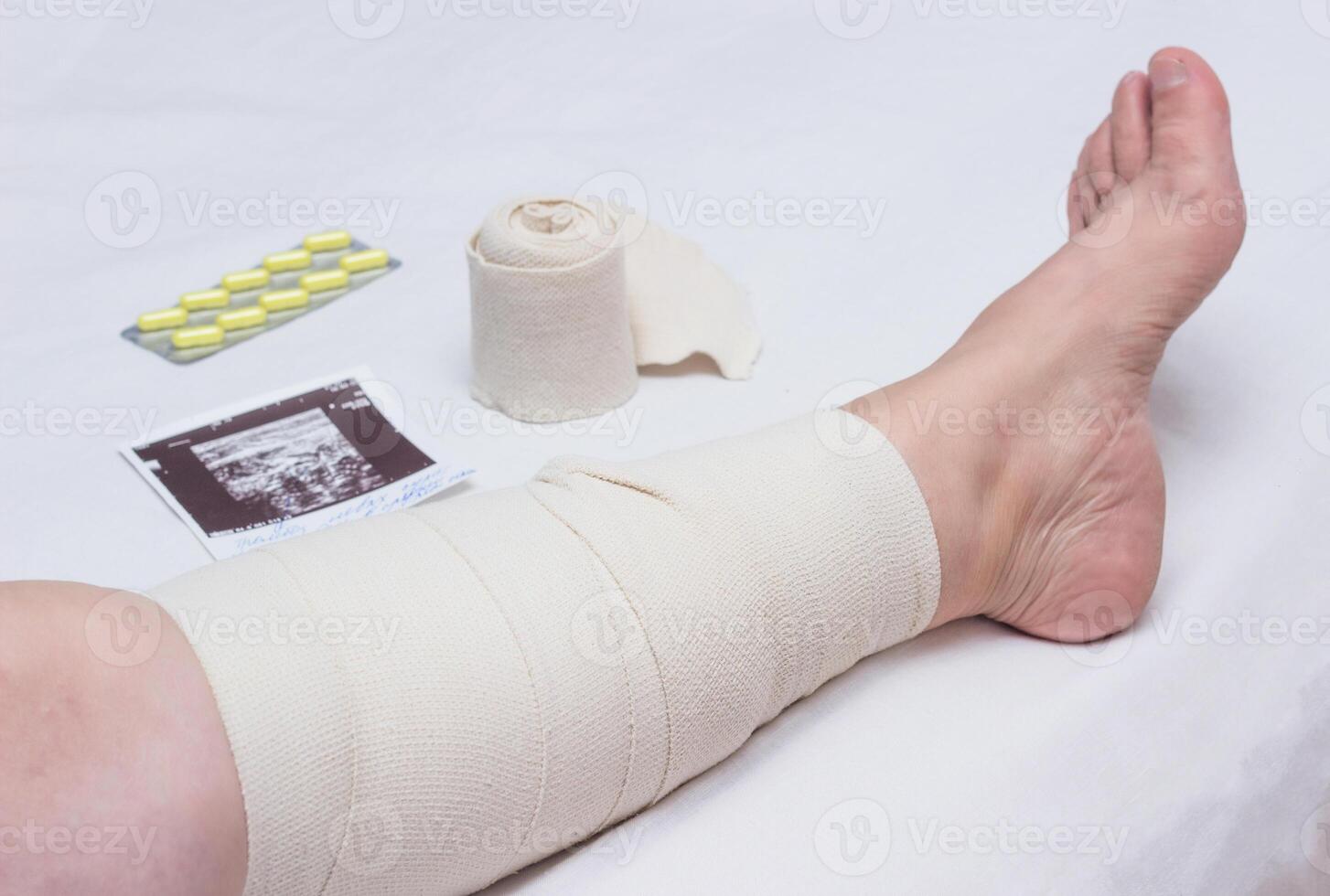 Compression therapy for varicose veins in a woman's legs, treatment of varicose veins with an elastic bandage, vascular photo