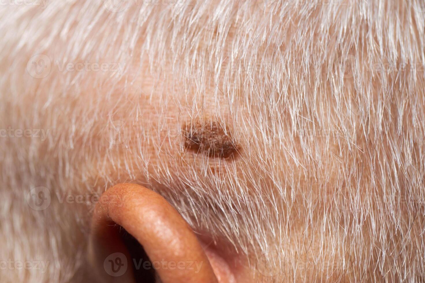 Brown mole on the head of an elderly person, nevus and melanoma, close-up, dermatology photo