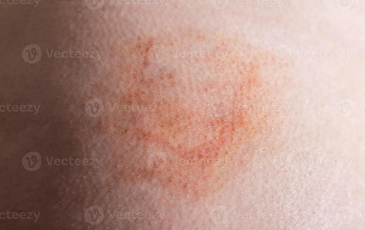Bruise and subcutaneous lump on the patient s skin after injections. Post-injection infiltrates, close-up photo