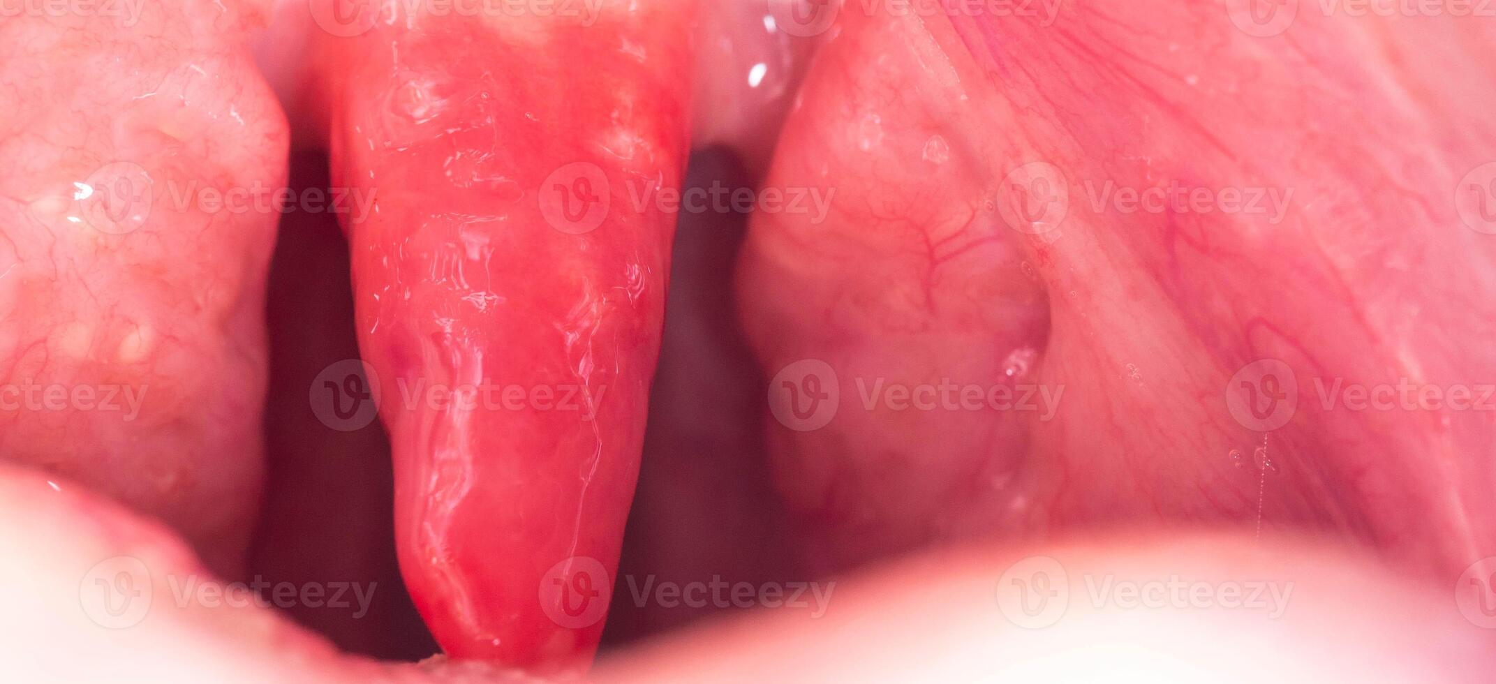 Long uvula with inflammation of infections and viruses. Treatment of uvulitis in children and adults. Sore throat, sore throat, macro. Copy space for text. Allergy photo