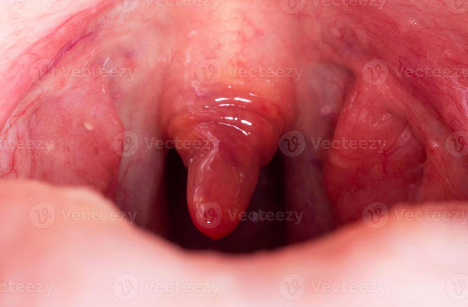 Inflammation of the uvula in the oral cavity due to infection and virus. Treatment of the disease is uvulitis. Red throat due to illness, close-up. Allergy photo