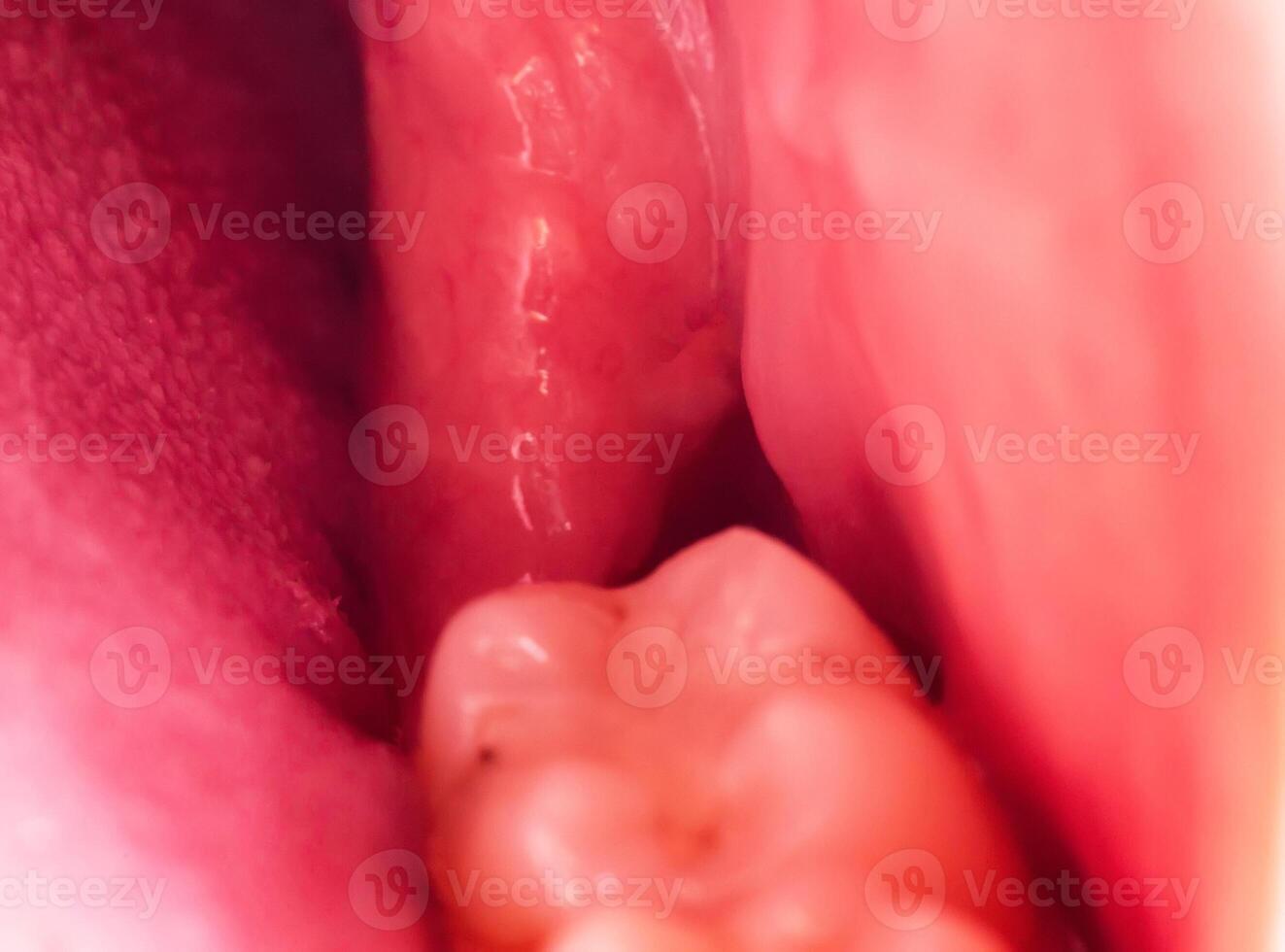 recess after complex impacted wisdom tooth extraction, traumatic healing. Dry socket, alveolitis, macro. Copy space for text photo