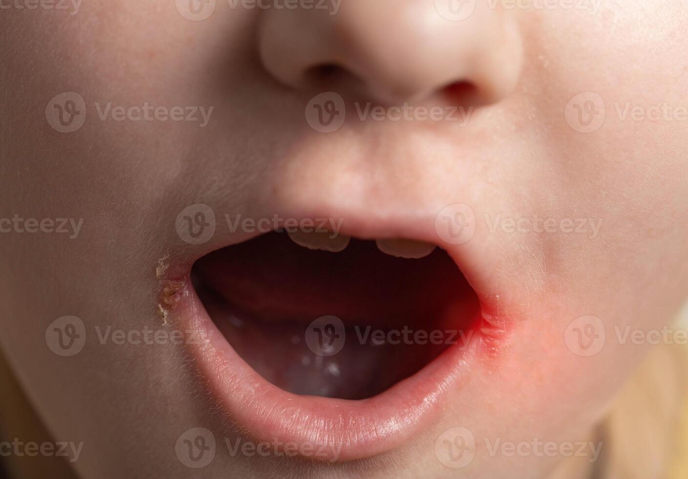 Seizures on the corners of the lips of a child s mouth. Bacterial disease of inflammation of the corners of the lips. Angular stomatitis with reduced immunity in a child, macro photo