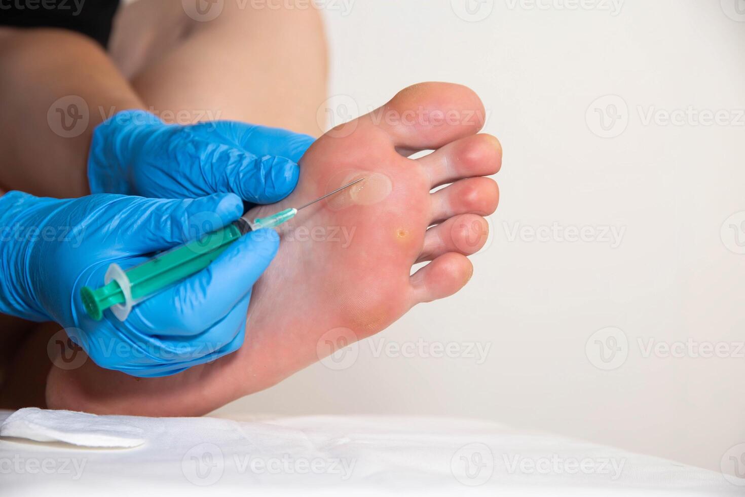 surgery to pierce and remove fluid from a callus on the foot, close-up photo