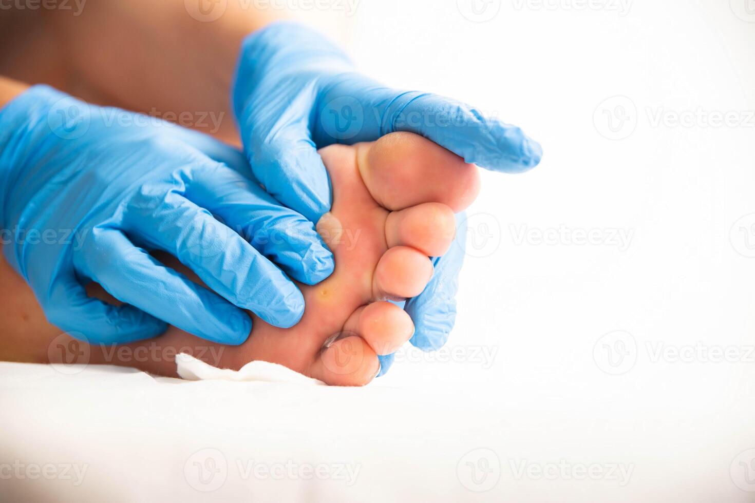 Doctor squeezing and removing a callus on the foot, close-up. Dermatoscopy photo