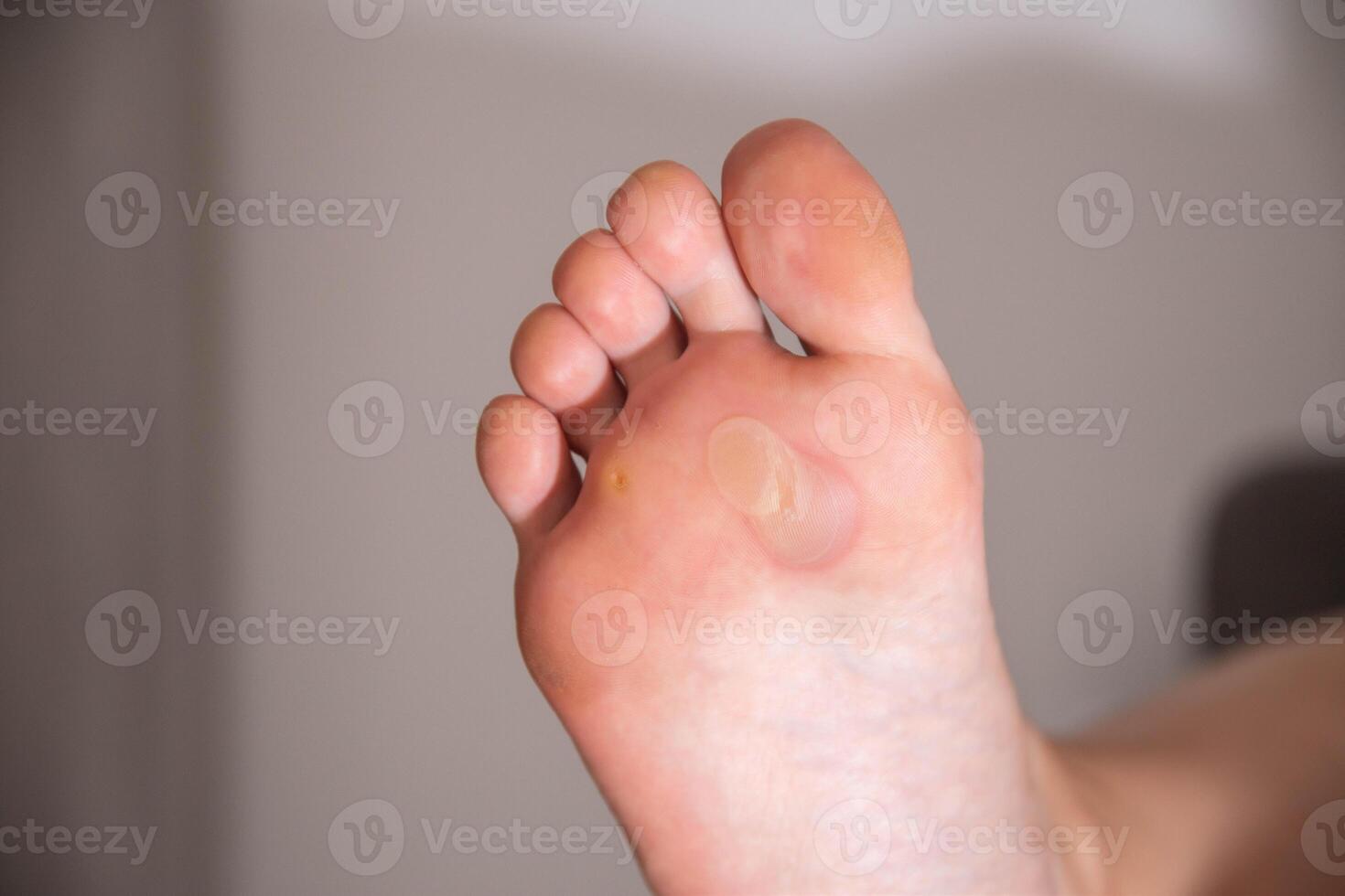 A person's foot has a large callus on its foot due to rubbing from uncomfortable shoes. Rod wart on the sole of the foot, close-up photo