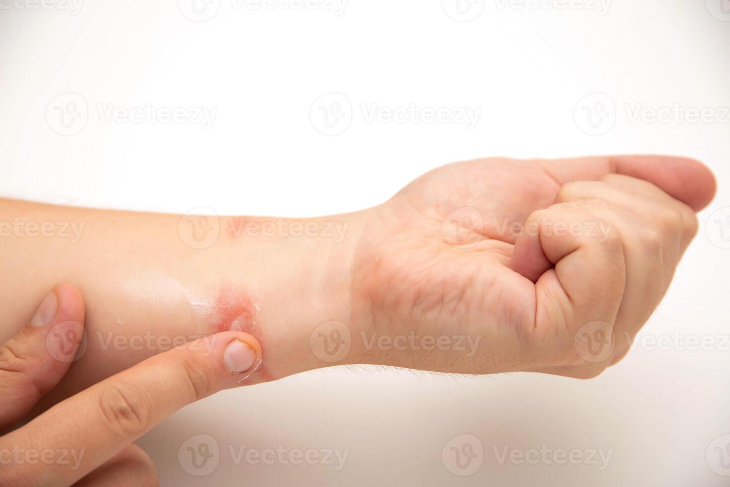 A man rubs his finger over the redness and irritation on the skin of his wrist caused by a silicone watch strap. Allergies and dermatitis. Copy space for text photo