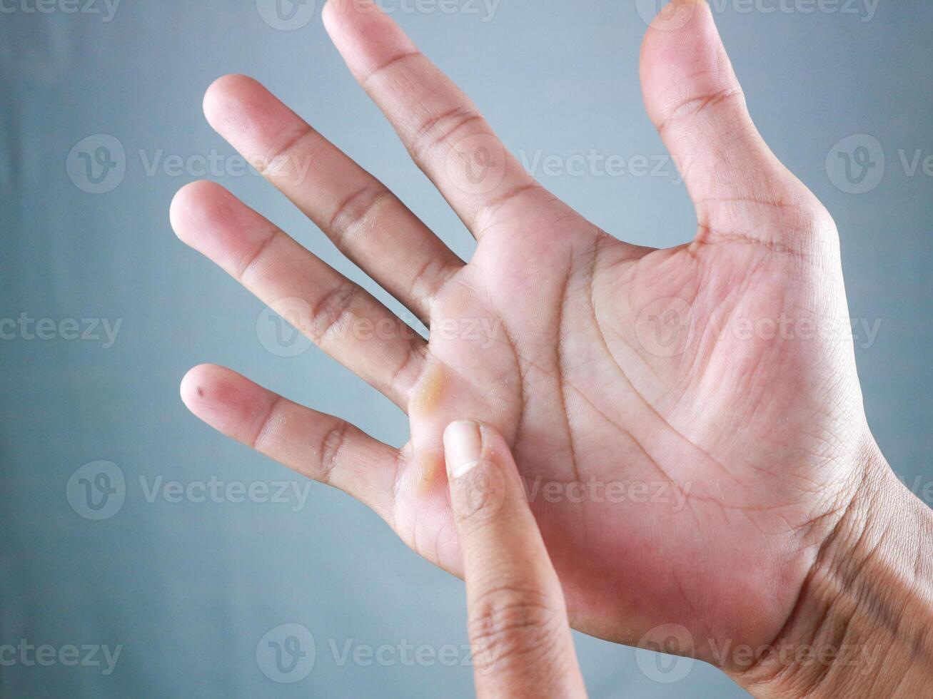 closeup of fingers shows callus hands from working hard photo
