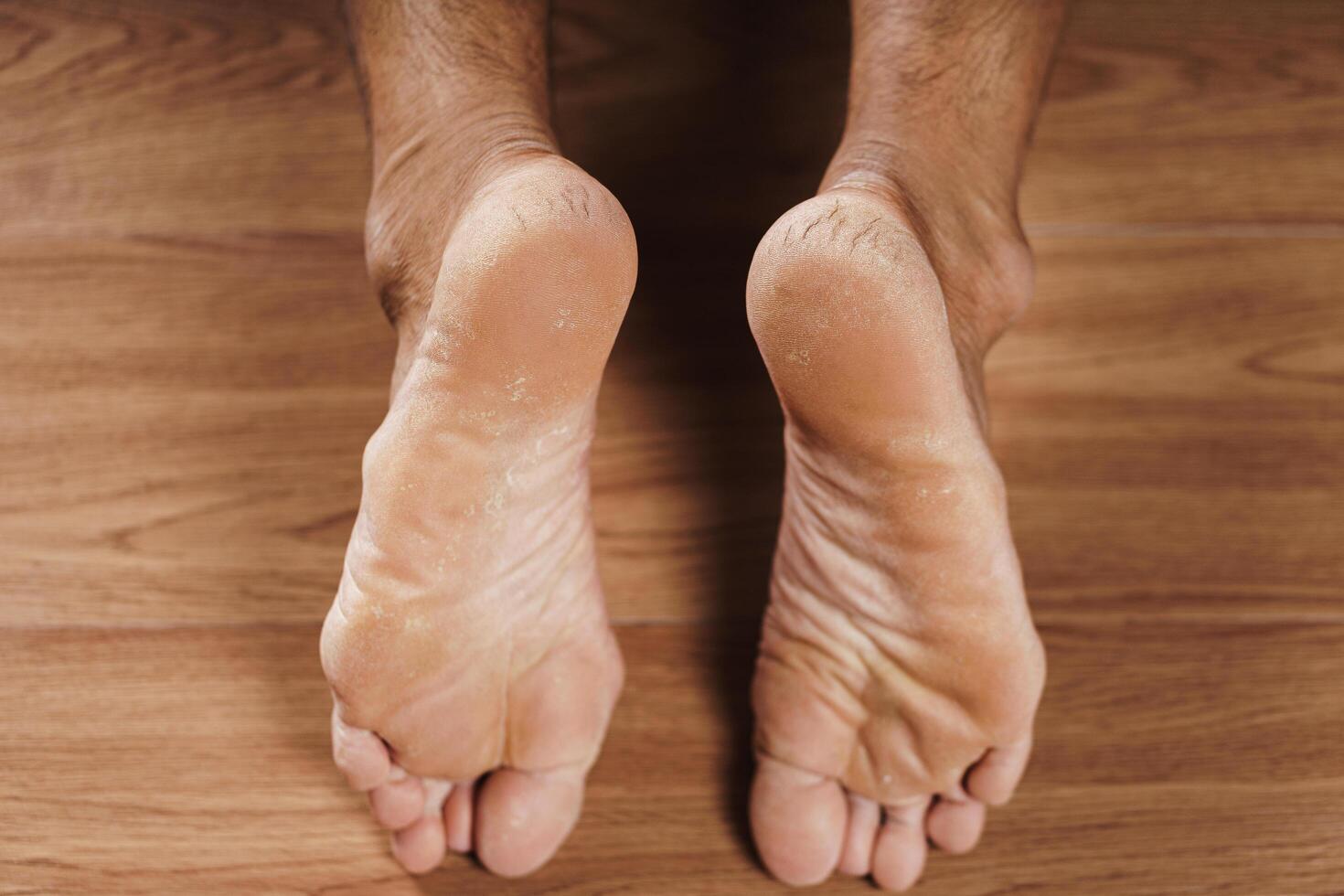 A pair of feet with dry cracked hard heel skin on the floor. healthcare and medical concept. photo