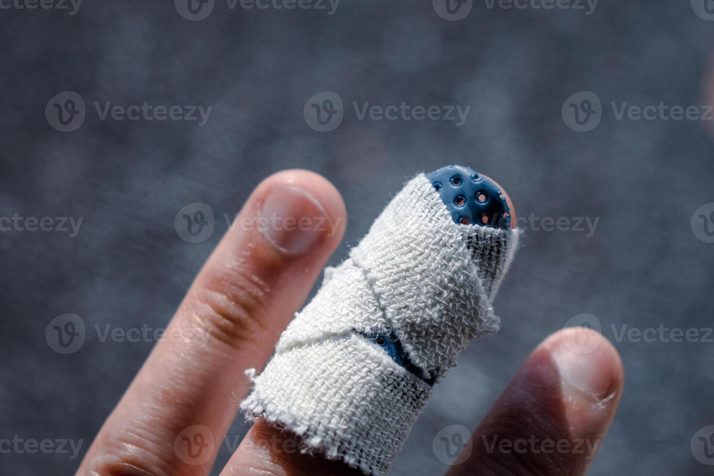 Mallet finger with custom orthosis on the middle finger to immobilize the last phalanx following joint trauma photo