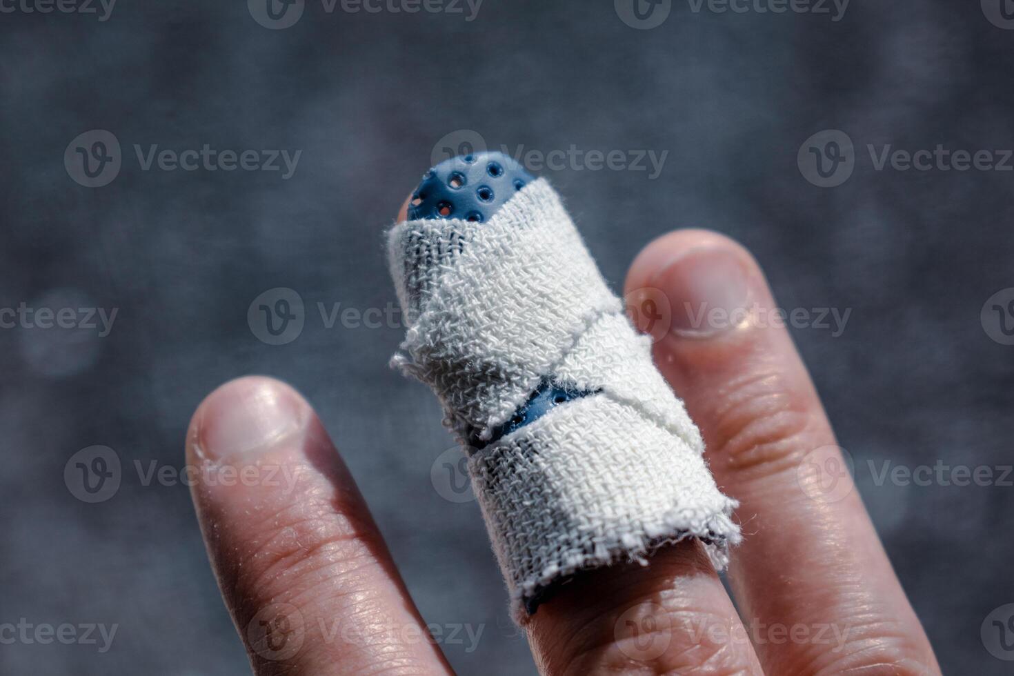 Mallet finger with custom orthosis on the middle finger to immobilize the last phalanx following joint trauma photo