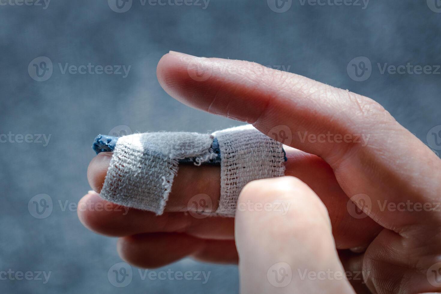 Mallet finger with custom orthosis on the middle finger to immobilize the last phalanx following joint trauma photo
