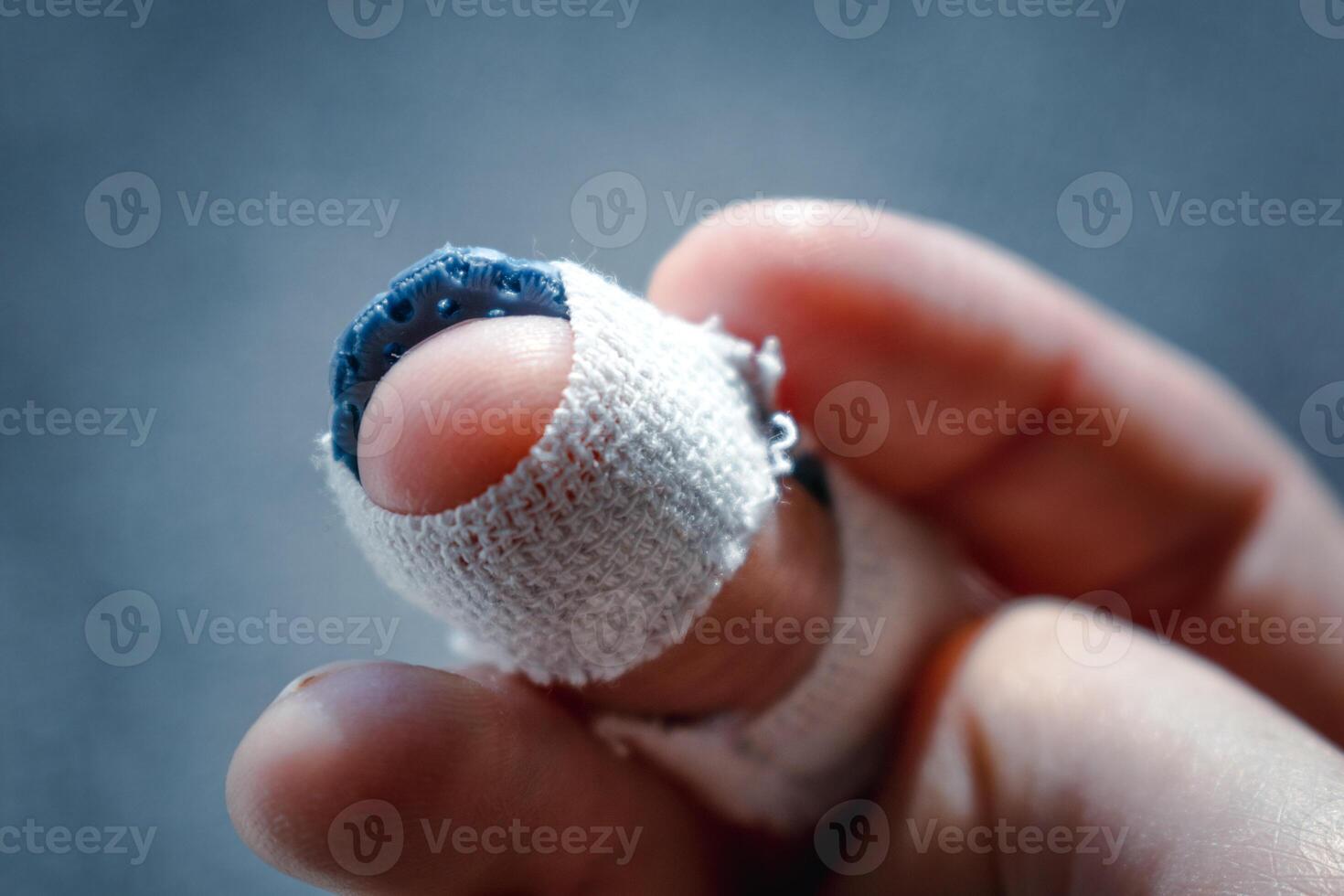 Mallet finger with custom orthosis on the middle finger to immobilize the last phalanx following joint trauma photo