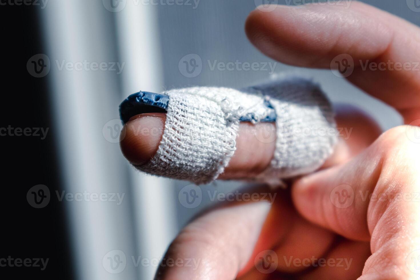 Mallet finger with custom orthosis on the middle finger to immobilize the last phalanx following joint trauma photo