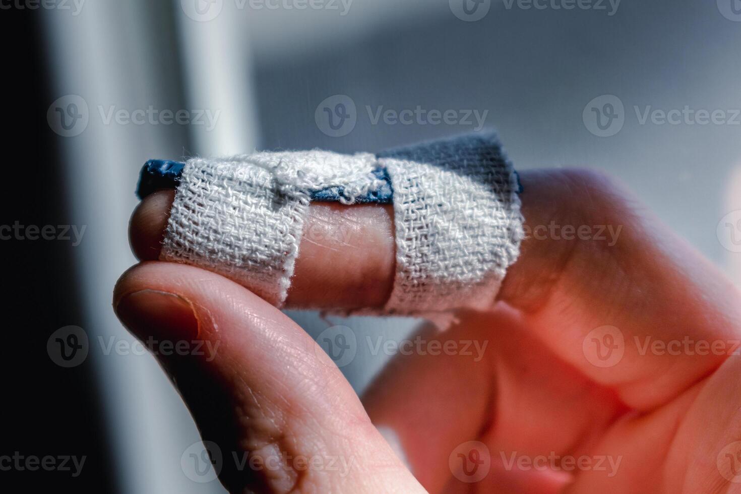 Mallet finger with custom orthosis on the middle finger to immobilize the last phalanx following joint trauma photo
