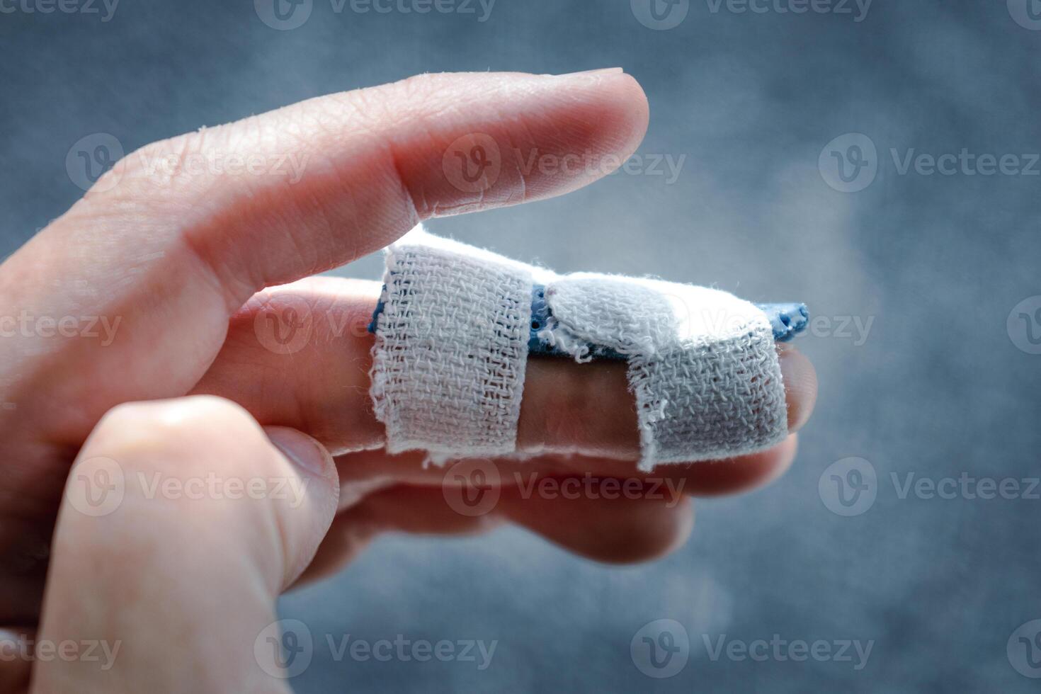 Mallet finger with custom orthosis on the middle finger to immobilize the last phalanx following joint trauma photo