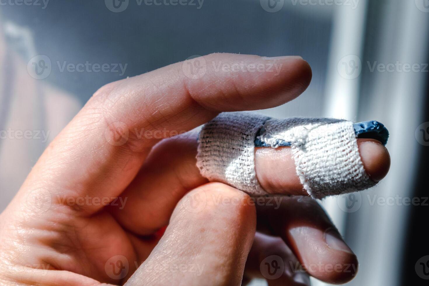 Mallet finger with custom orthosis on the middle finger to immobilize the last phalanx following joint trauma photo