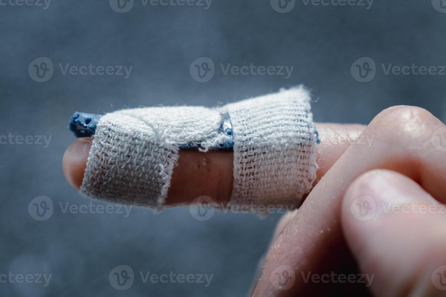 Mallet finger with custom orthosis on the middle finger to immobilize the last phalanx following joint trauma photo