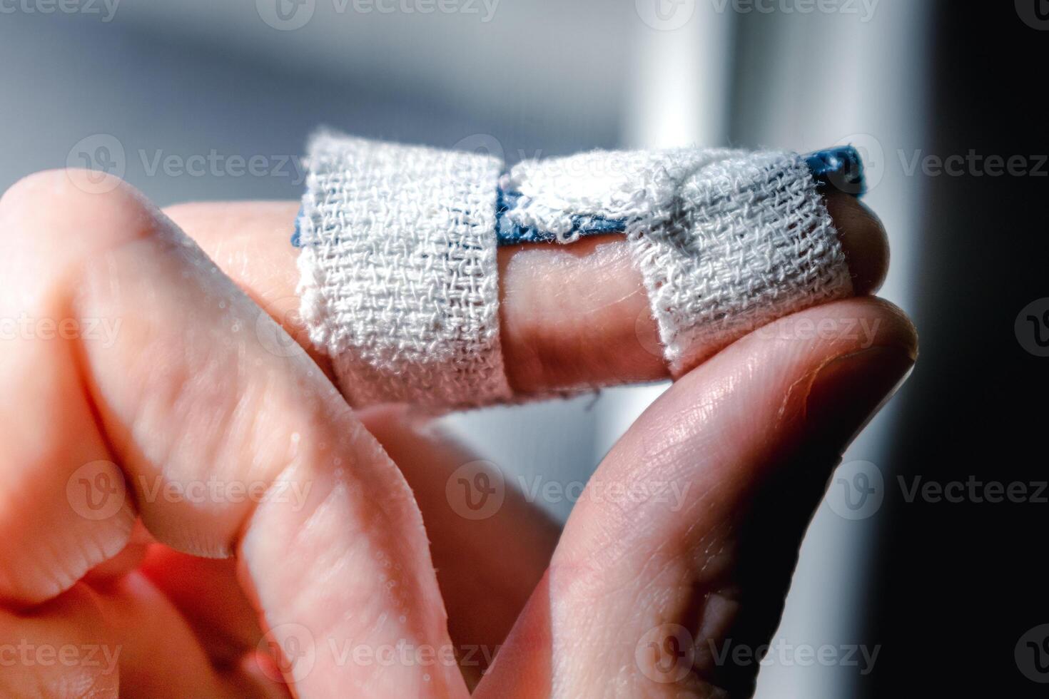 Mallet finger with custom orthosis on the middle finger to immobilize the last phalanx following joint trauma photo