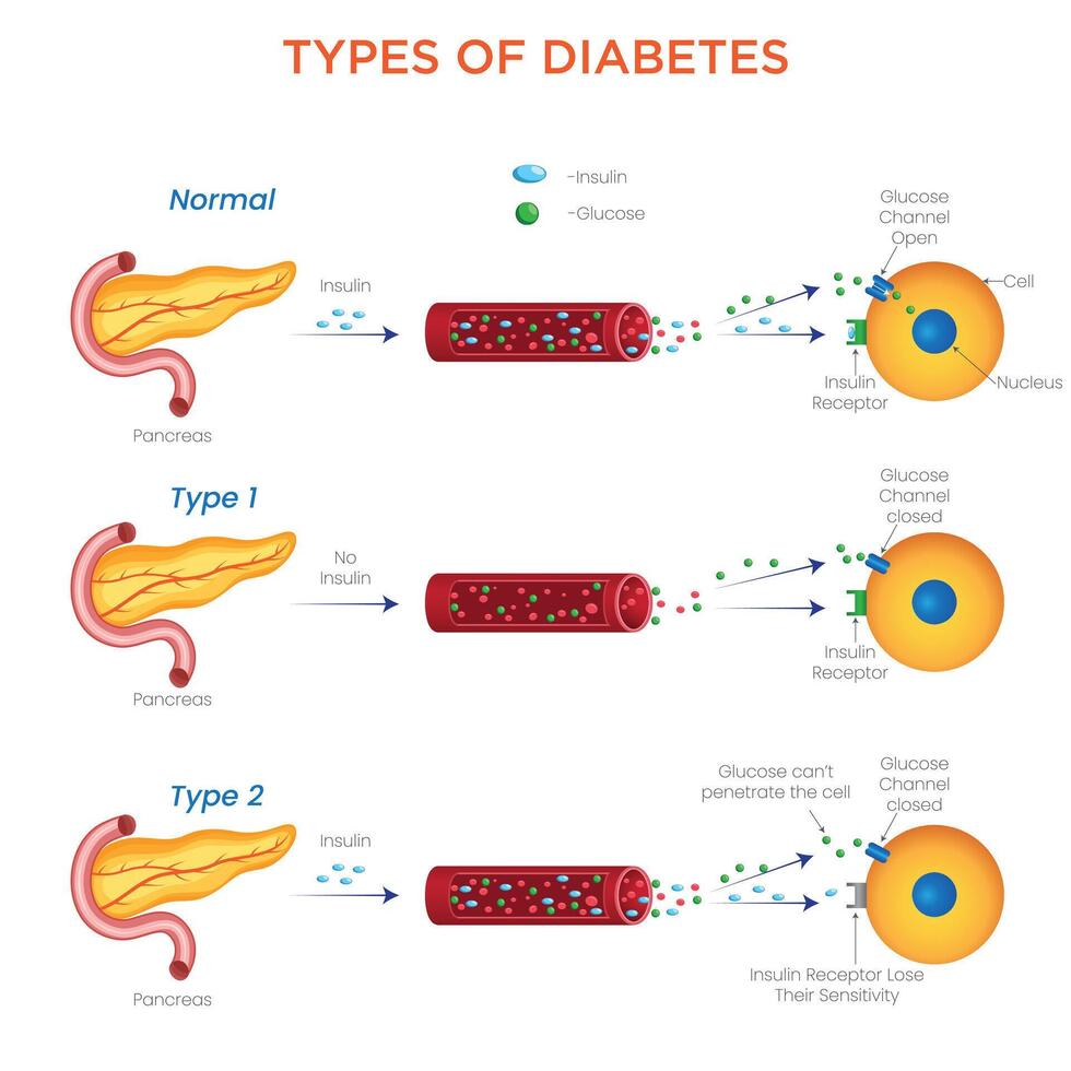 Understanding Type 1, Type 2, and Gestational Diabetes vector
