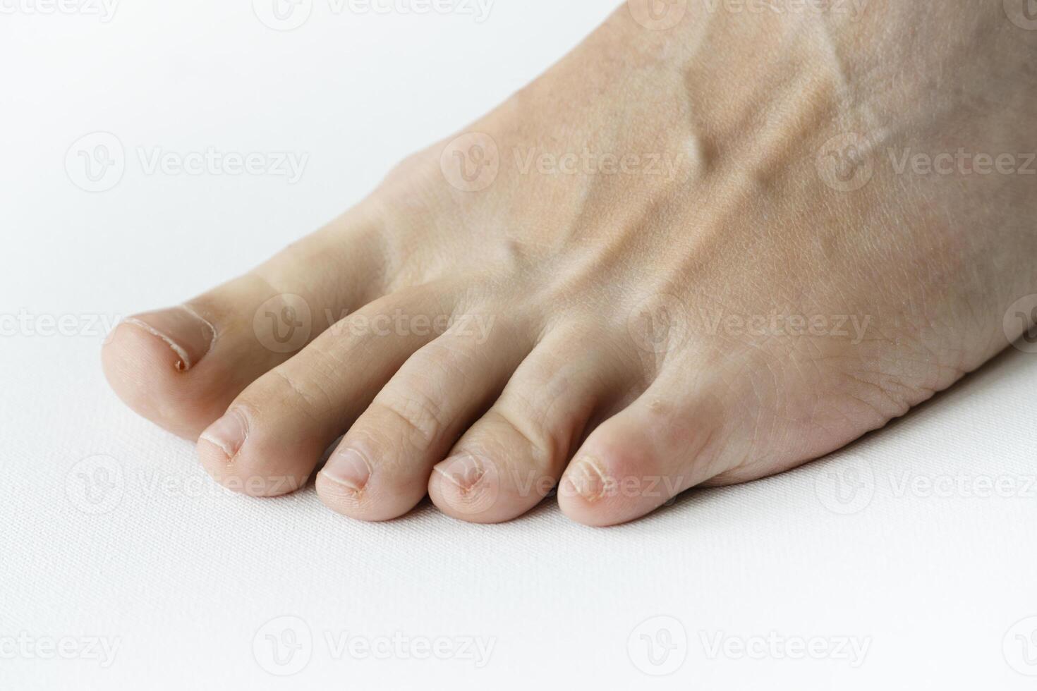 Foot treatment without pedicure in SPA, unkempt, the patient's foot without manicure on the podologist's chair. Patient on medical pedicure procedure, visiting podiatrist. Peeling feet. photo