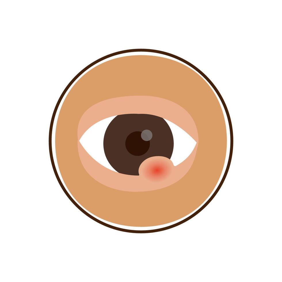 hordeolum eyes infection and abscess disease vector