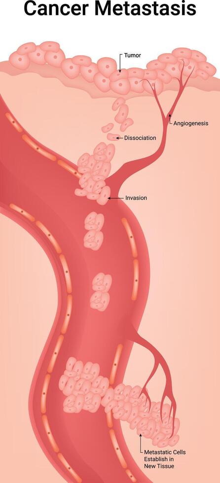 Cancer Metastasis Science Design Illustration Diagram vector