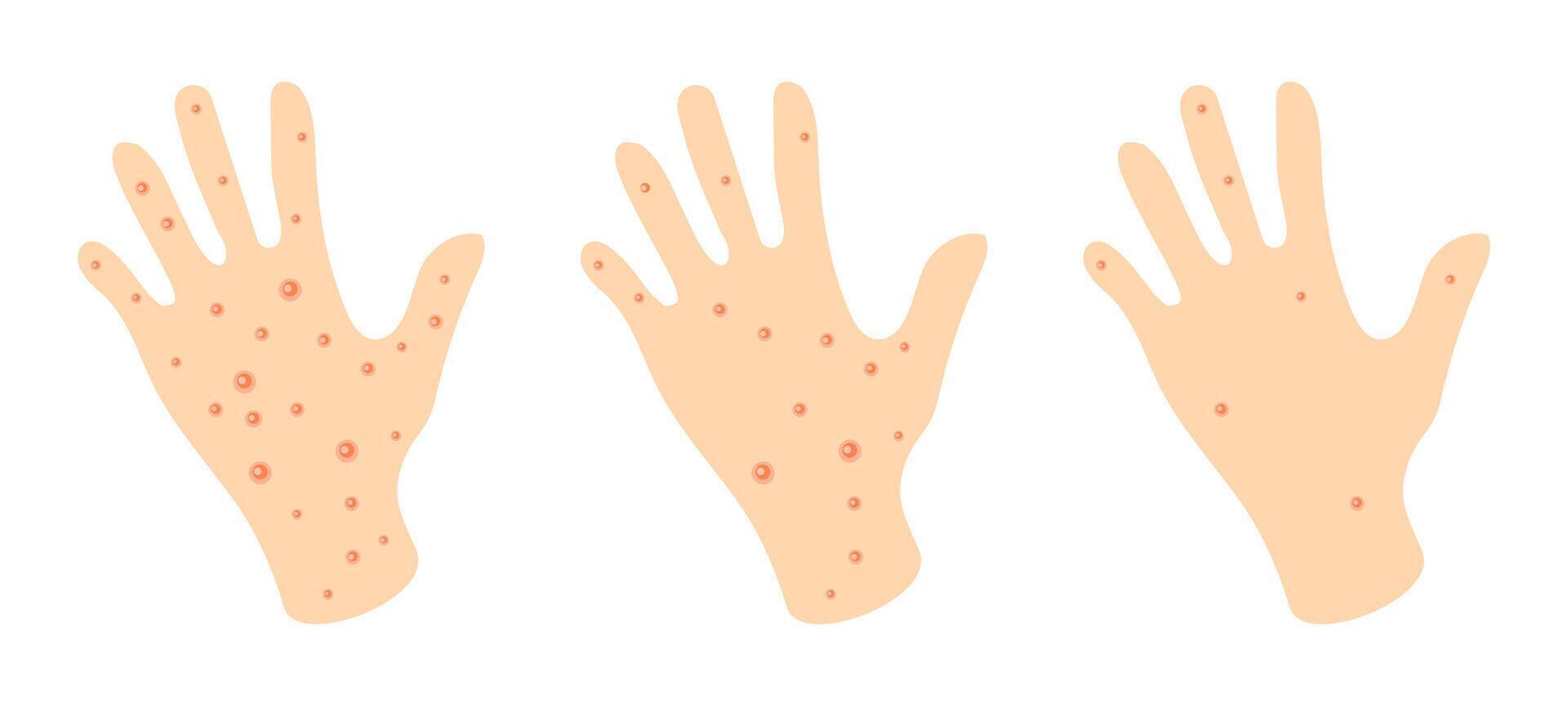 Visual representation of skin conditions showing hands with varying levels of irritation and redness. vector