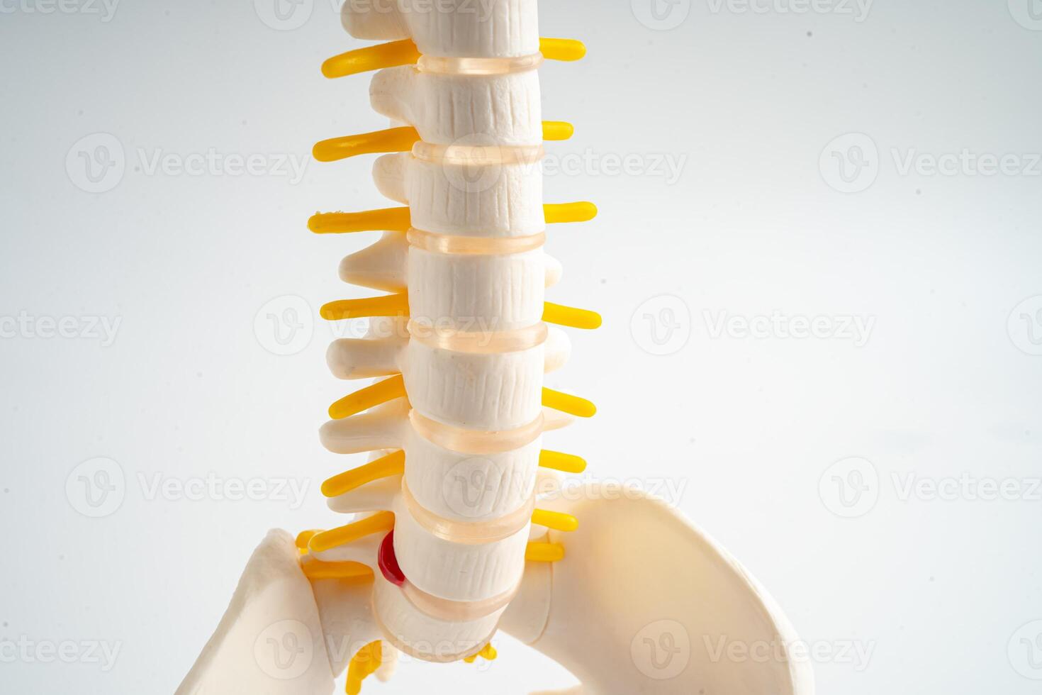 Lumbar spine displaced herniated disc fragment, spinal nerve and bone. Model for treatment medical in the orthopedic department. photo
