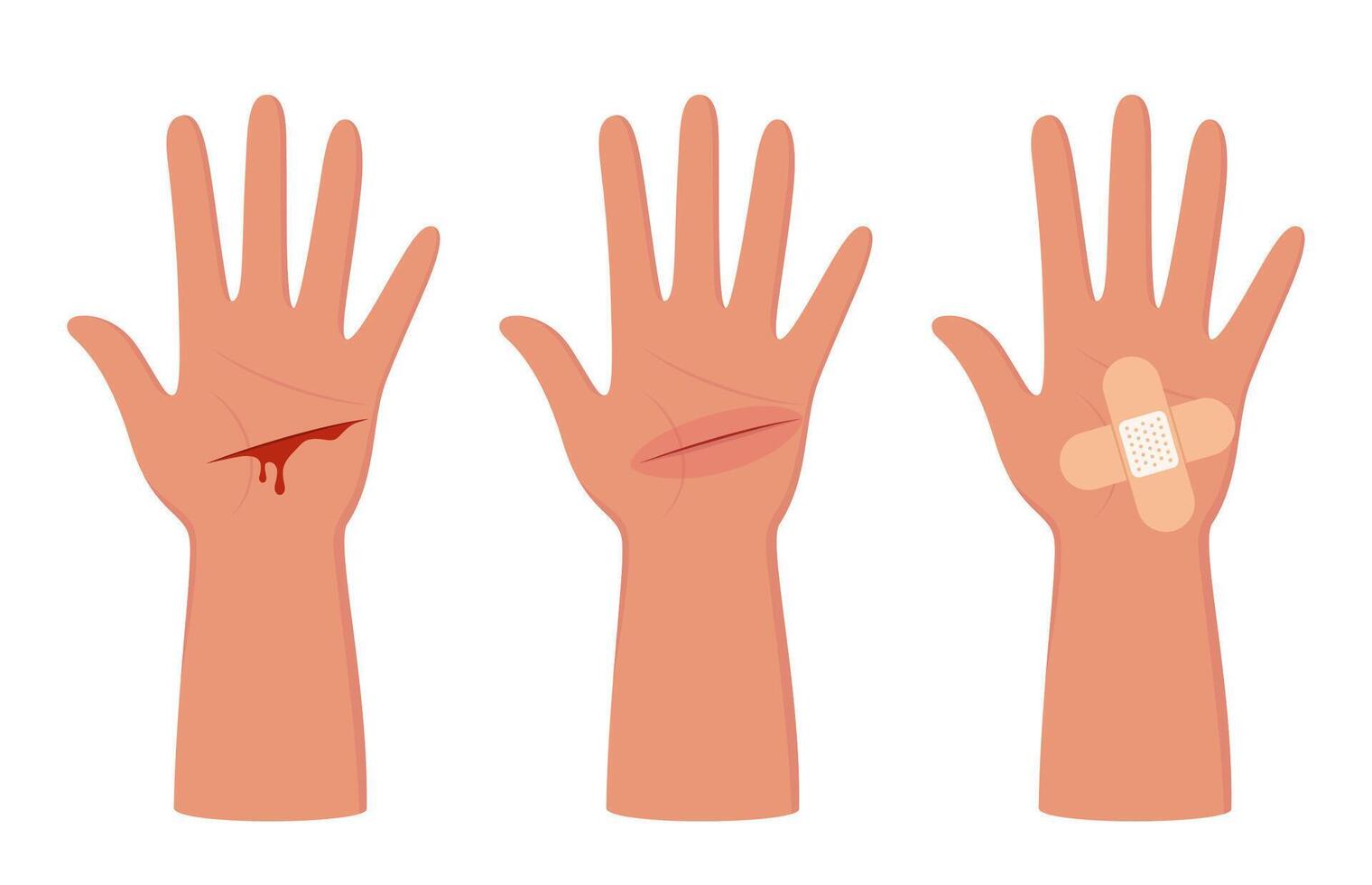 Bleeding cut on the palm, emergency situation. First aid treatment for wound on skin. Trauma, treatment procedure. illustration. vector