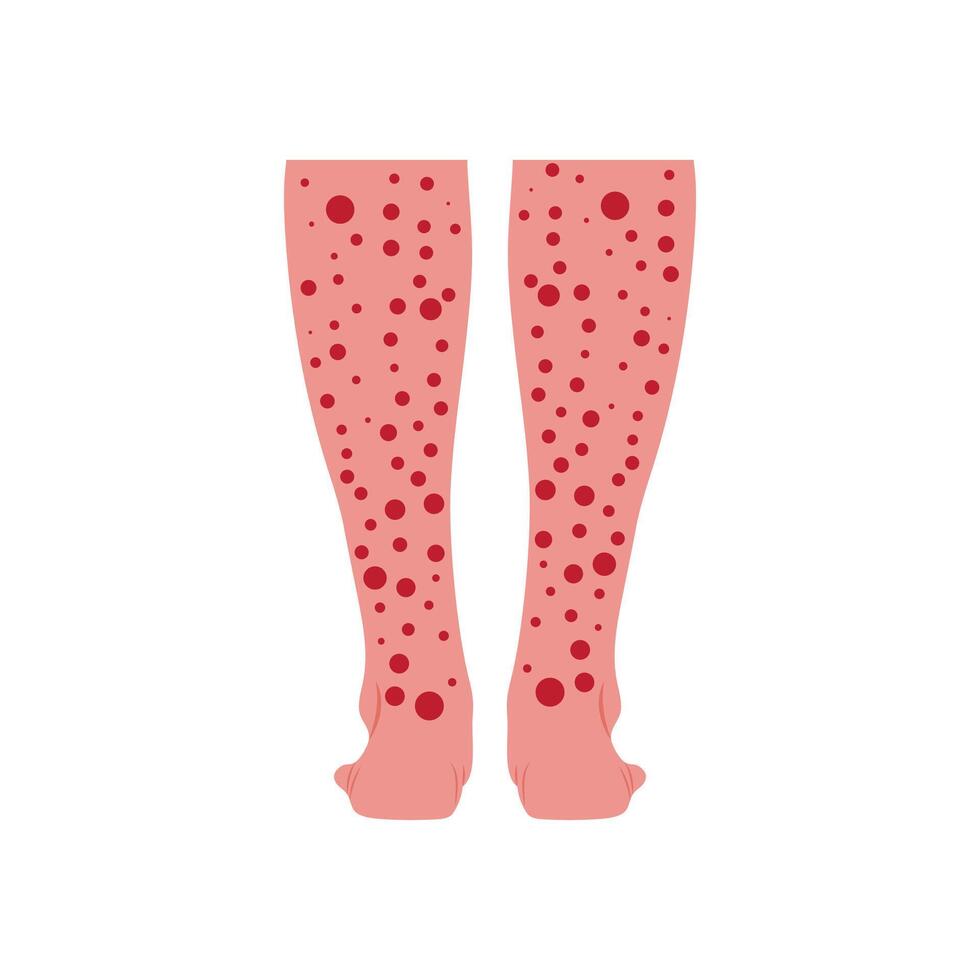 Red Spots on Leg, Cardiovascular Disease Illustration Icon vector