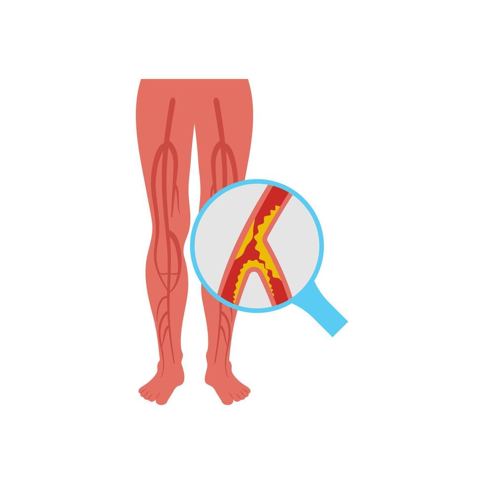 Peripheral Artery Disease, Cardiovascular Disease Illustration Icon vector