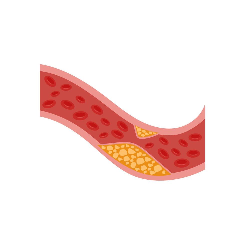 High Cholesterol, Cardiovascular Disease Illustration Icon vector