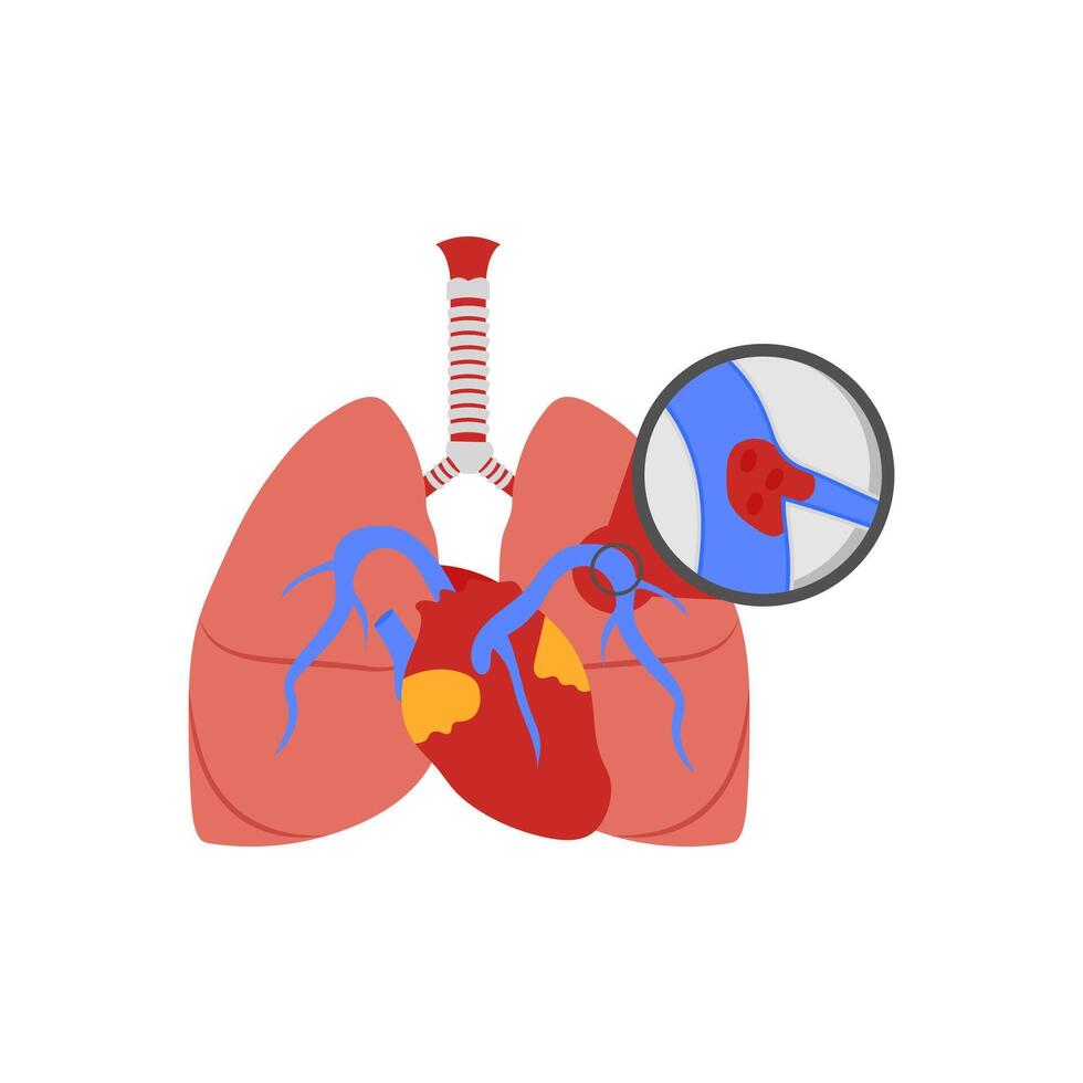 Pulmonary Embolism, Cardiovascular Disease Illustration Icon vector