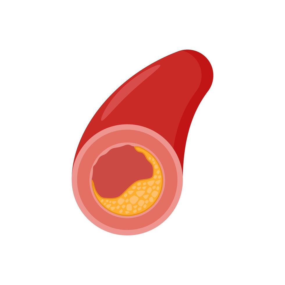 Atherosclerosis, Cardiovascular Disease Illustration Icon vector