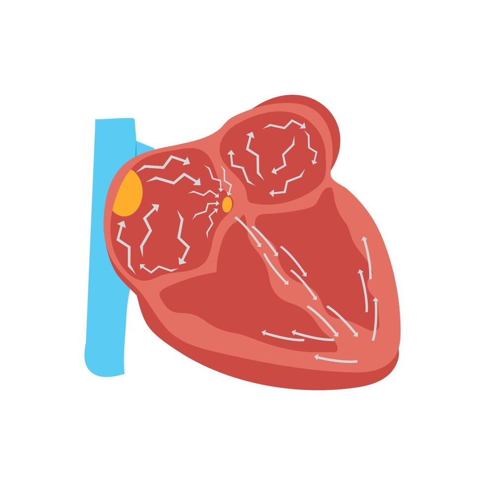 Atrial Fibrillation, Cardiovascular Disease Illustration Icon vector