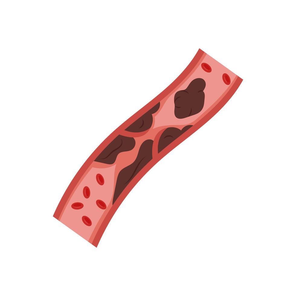 Deep Vein Thrombosis, Cardiovascular Disease Illustration Icon vector