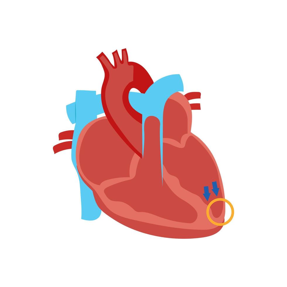 Dilated Cardiomyopathy, Cardiovascular Disease Illustration Icon vector