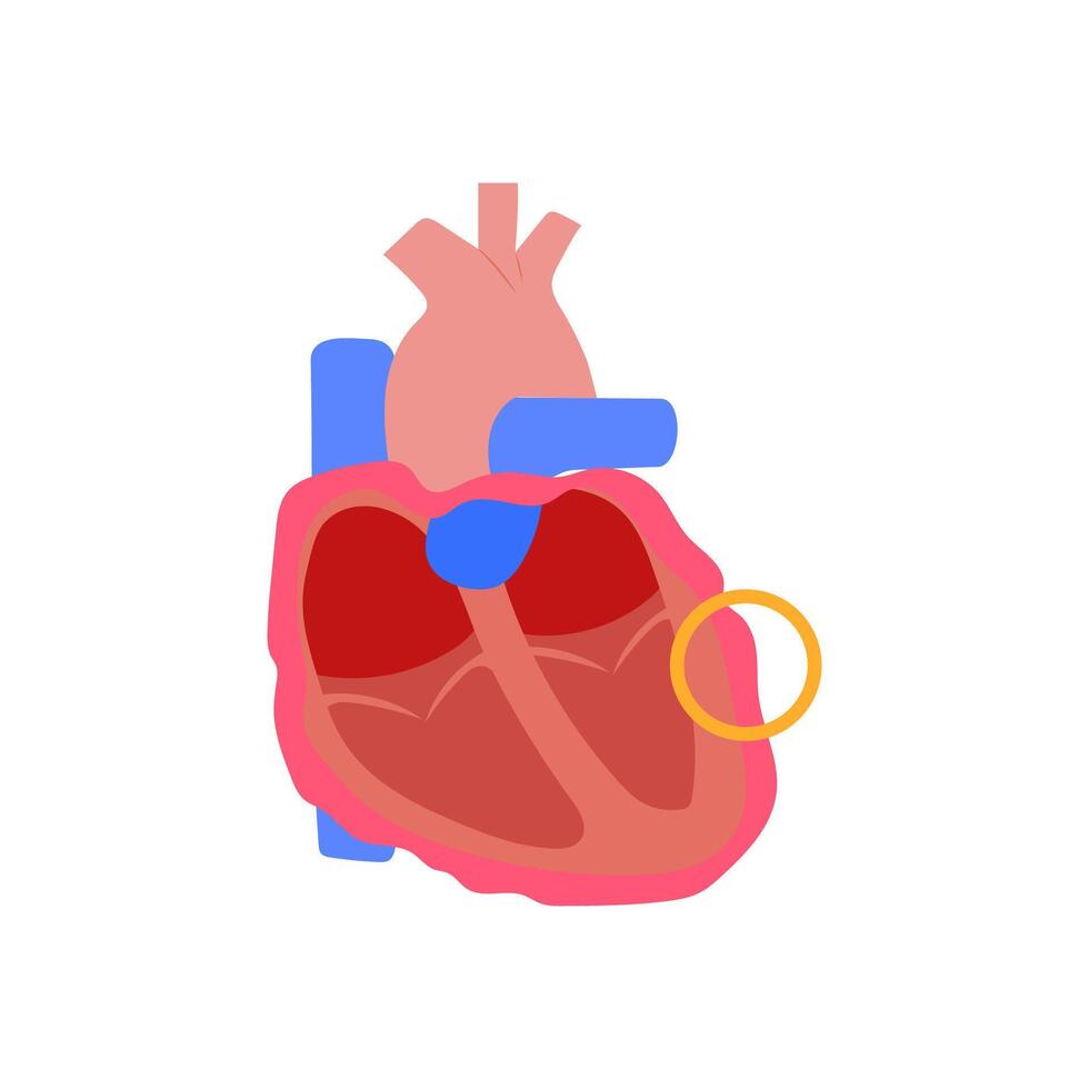 Pericarditis, Cardiovascular Disease Illustration Icon vector