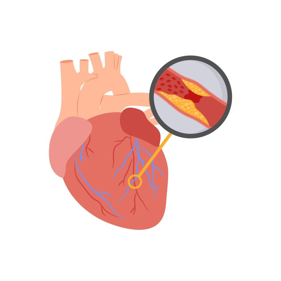 Myocardial Infarction, Cardiovascular Disease Illustration Icon vector