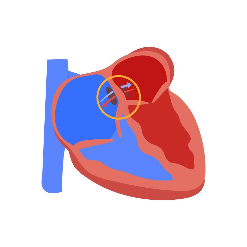 Atrial Septal Defect, Cardiovascular Disease Illustration Icon vector