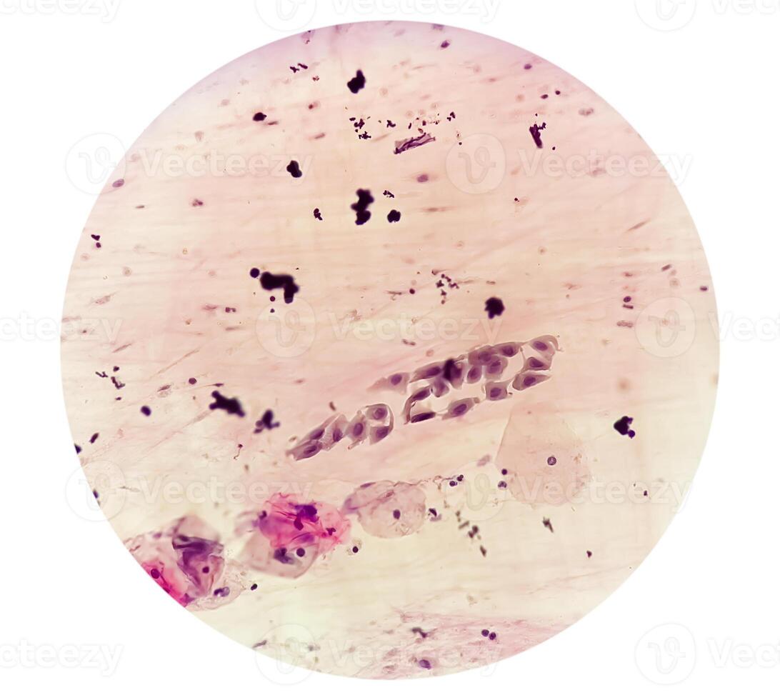 Paps smear analysis, HPV related change photo
