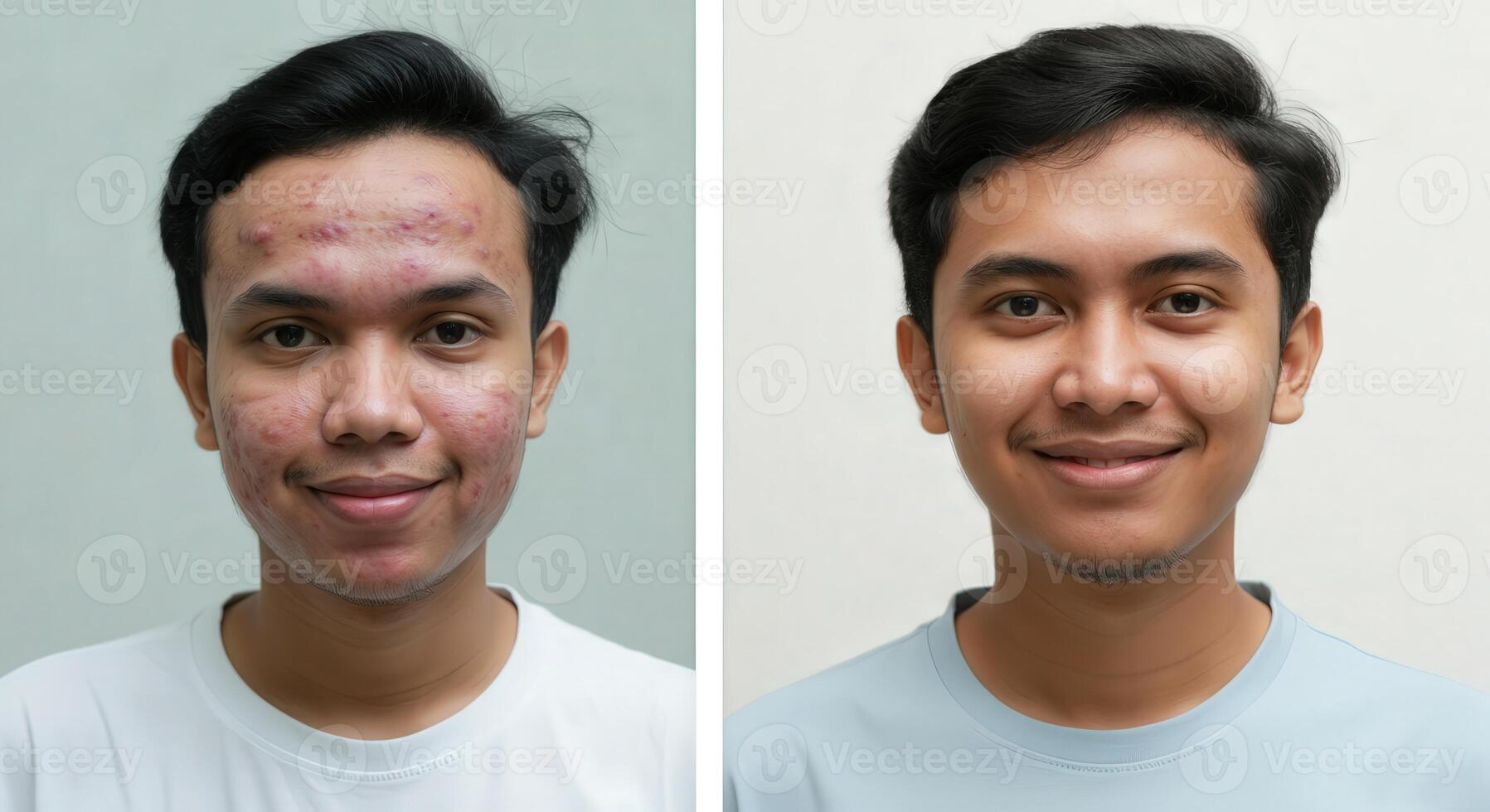 Asian male skin transformation before and after treatment for acne improvement and clear complexion photo