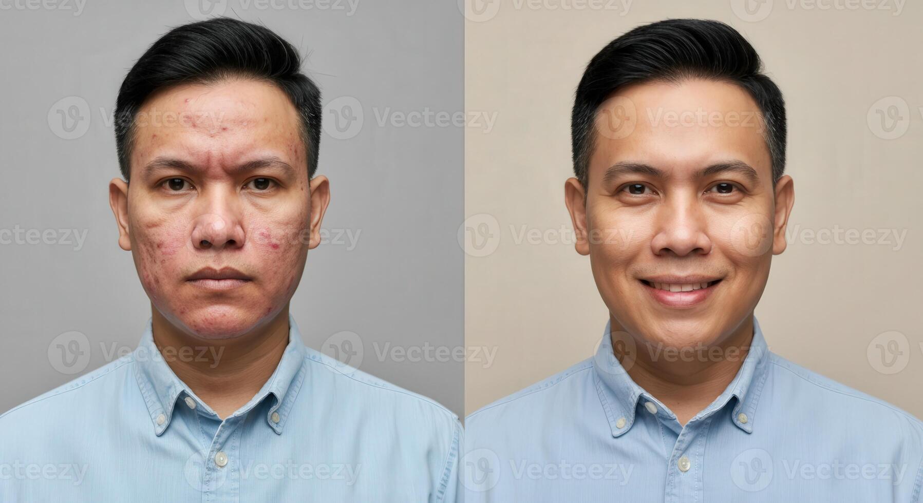 Transformation journey of asian male with acne improvement in skincare routine photo