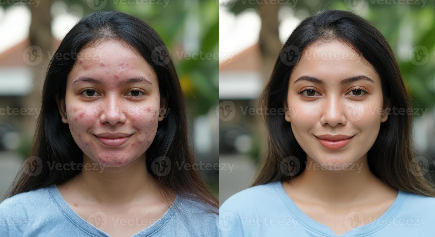 Young asian woman before and after skincare treatment for clear complexion photo