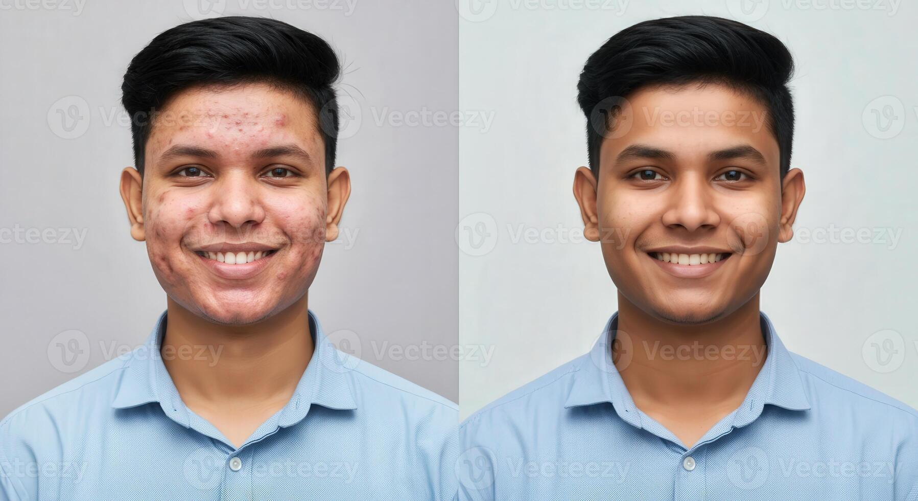 Before and after skincare transformation of a young south asian male model photo